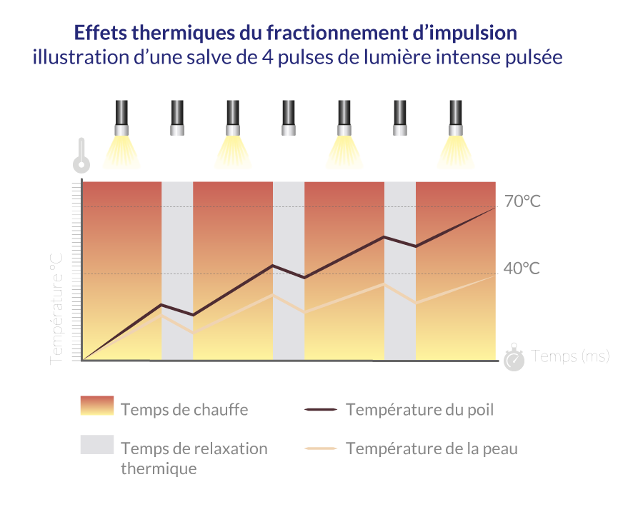 illustration de l'effet thermique du fractionnement d'impulsion de la lumière pulsée SHR